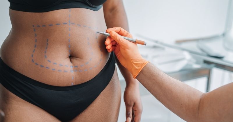 Factors of Tummy Tuck Cost
