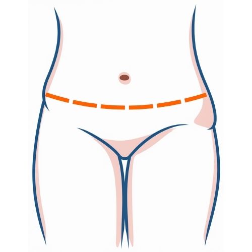 Extended Tummy Tuck