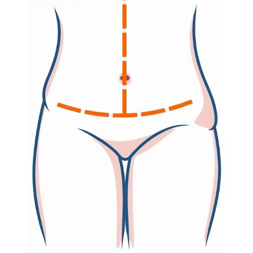 Fleur-De-Lis Tummy Tuck