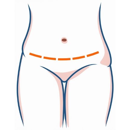 Full Tummy Tuck