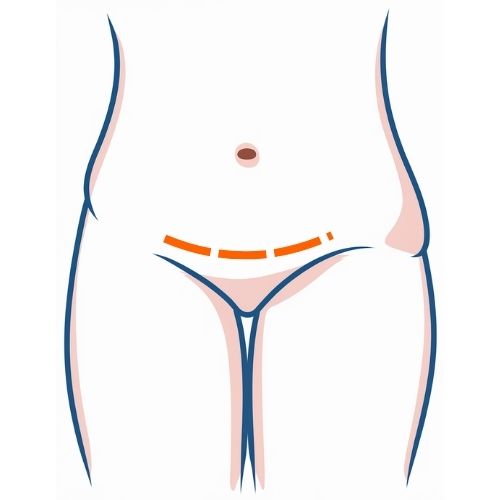 Mini Tummy Tuck