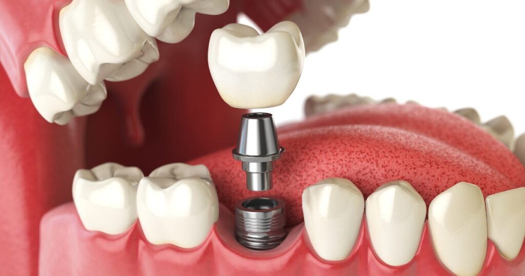 Alternative Options to Dental Implants