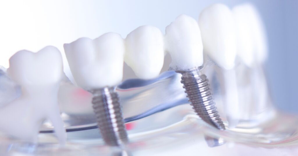 Multiple Teeth Implants