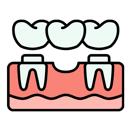 Dental Bridge