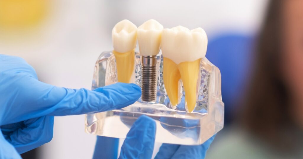 Factors Affecting Dental Implants Cost
